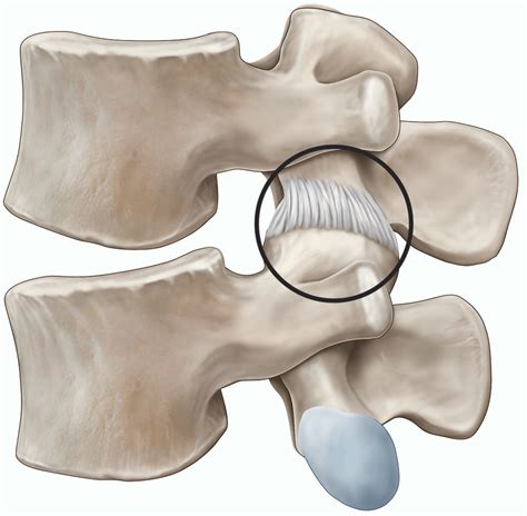 Facet joint injection | healthdirect