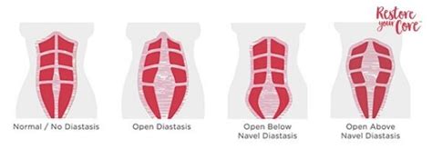 Diastasis Recti Surgery | Procedure Overview | Will You Need It? - RYC®