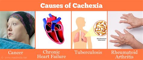 Cachexia - Causes Symptoms Diagnosis Treatment & Prevention