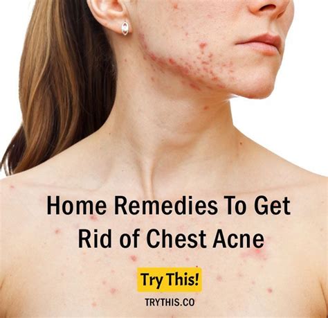 Home Remedies To Get Rid of Chest Acne | Home remedies for acne, Chest ...