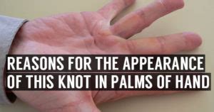 Knots and Lump in Palm of Hands | Symptoms & Home Treatment