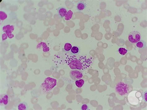 Leishmania visualization on bone marrow aspiration sample 2