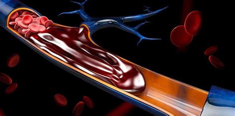 Blood Clot in Brain: Symptoms, Diagnosis & Treatment