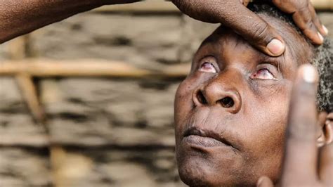 Trachoma: Causes, Symptoms, Stages and Prevention | Healthtian