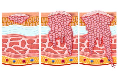 Neoplasia: o que é, tipos, causas, tratamentos - Mundo Educação