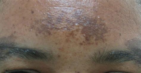 A Unique Acne Treatment for Black Skin?