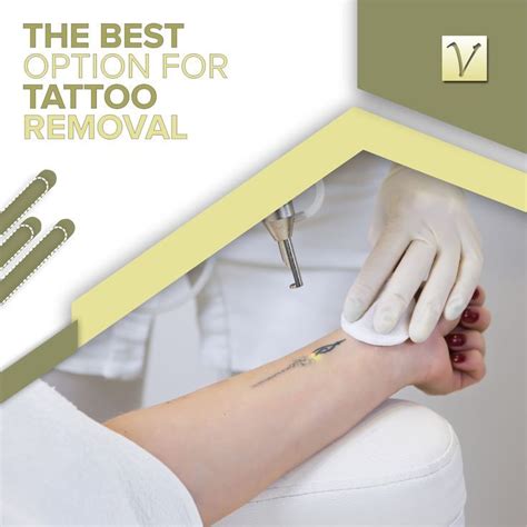 Laser tattoo removal is the “gold standard” of tattoo removal options ...