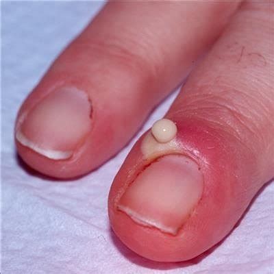 How To Treat Paronychia Effectively | Nail Care Hub