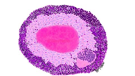 TUBERCULOUS LYMPHADENITIS - Pathology Made Simple