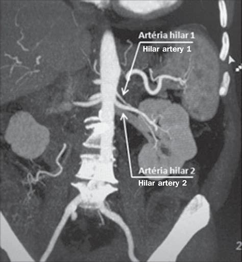 SciELO - Brasil - Multidetector computed tomography angiography of the renal arteries: normal ...