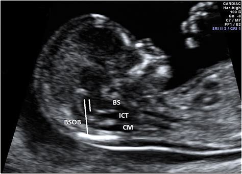 The detection of spina bifida at 11–13+6 weeks' gestation - Borg - 2017 - Sonography - Wiley ...