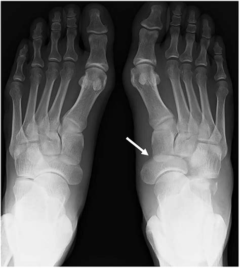 A plain radiograph shows lateral dislocation of the naviculocuneiform ...