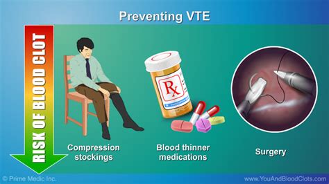 Preventing and Treating Venous Thromboembolism (VTE)