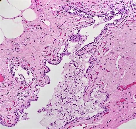 Duct Ectasia Histology