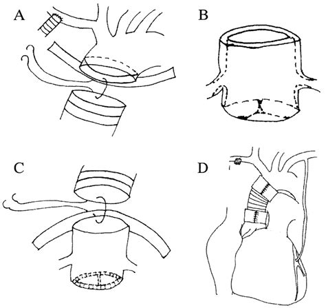 A: A woven Dacron graft was anastomosed distally to the transected ...