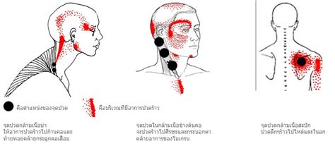 Myofascial Pain Syndrome (MPS) - Arun Health Garden