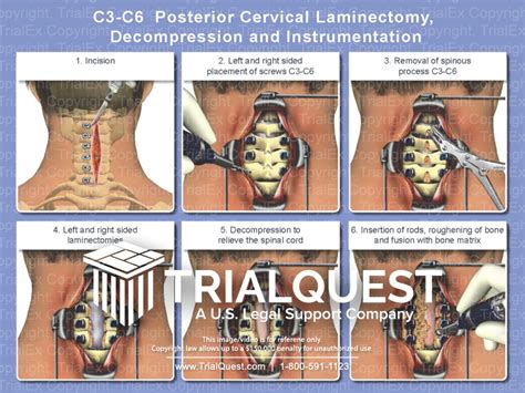 C3-C6 Posterior Cervical Laminectomy, Decompression and Instrumen...