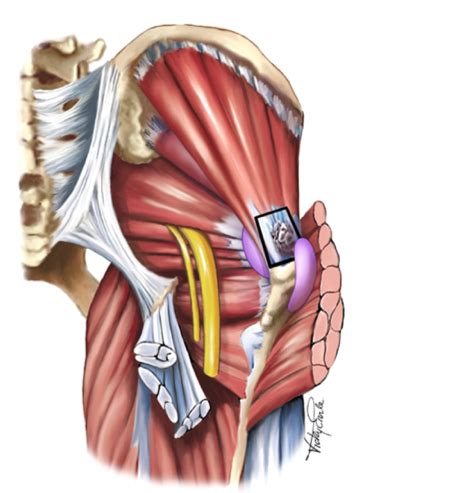 GLUTEAL TENDINOPATHY - Enhance Physiotherapy