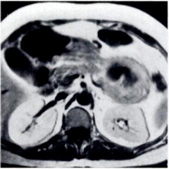 -45-year-oId man who had nonfunctional islet cell tumor and whose ...