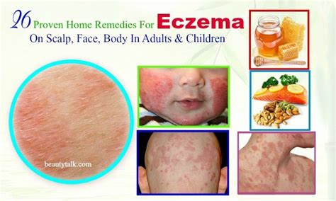 26 Proven Home Remedies For Eczema On Scalp In Adults & Kids