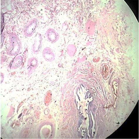 LP; H&E-stained fallopian tube with fimbriae lined by simple columnar... | Download Scientific ...