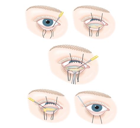 What is Lower Eyelid surgery? - Medical Tourist & Cosmetic Surgery