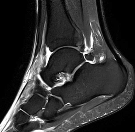 Ankle - (Low Ankle) Lateral ankle sprain - MRI Online