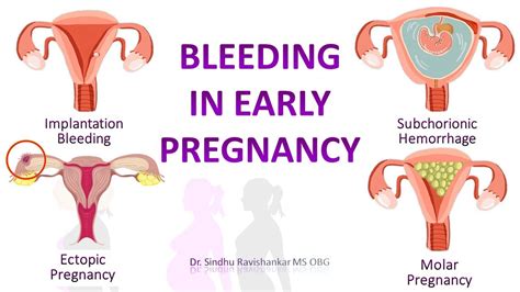 Pregnancy Implantation Bleeding