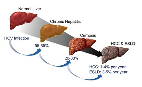 The Stages And Symptoms Of Hepatitis C Along With Its Treatment And ...