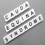 How Can You Treat Cauda Equina Syndrome?