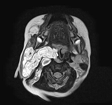 Scalp Arteriovenous Malformation Mistaken For A Heman - vrogue.co