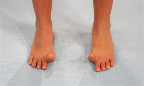 Pes Planus: The Truth About Flat Feet and Orthotics - Precision Movement