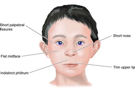 Overt Physical Symptoms of FAS – Understanding Fetal Alcohol Spectrum ...