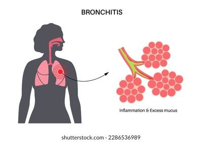 Bronchitis Concept Infection Lungs Bronchi Anatomical Stock Vector ...