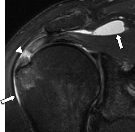 Subacromial Subdeltoid Bursitis Mri