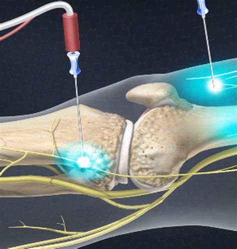 Genicular Nerve Ablation | Treatments | Twin Cities Pain Clinic