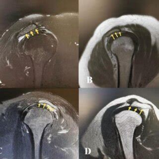 Type 1 acromion (A), Type 2 acromion (B), Type 3 acromion (C), and Type... | Download Scientific ...