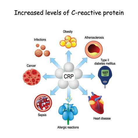 C-Reactive Protein (CRP) Inflammation Acute Phase Reactant, 57% OFF