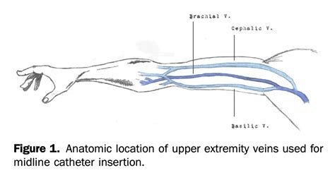 Midline IV Catheters – MED-TAC International Corp.