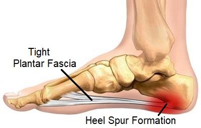 Heel Spur Symptoms, Causes, Treatment Exercises | atelier-yuwa.ciao.jp