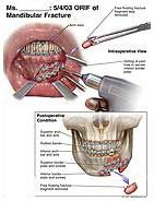 5/4/03 ORIF of Mandibular Fracture Medical Illustration