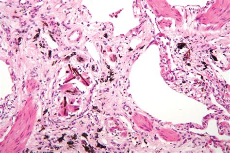 Bronchiectasis Histology