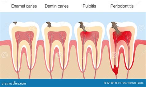 Infographic Dental Caries Stages Of Tooth Decay Stock Illustration ...