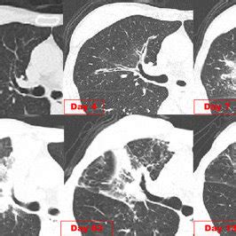 Chest CT shows diffuse peribronchial infiltrates and bronchial wall... | Download Scientific Diagram