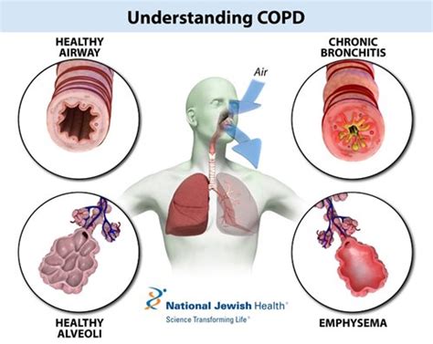 Understanding-the-impact-of-COPD-on-lungs - Cannabidiol 360