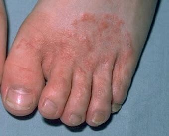 Foot Rash: Causes, Symptoms & Treatment