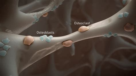 Osteoporosis Mechanism of Disease Animation | Medical Animation ...