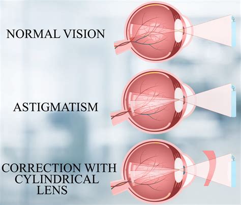 The eye defect, astigmatism can be corrected by using(a) Convex lens(b) Concave lens(c ...