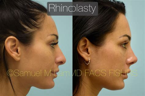 Hooked or Bumped Nose Rhinoplasty Dallas, Nose Job Plano, TX