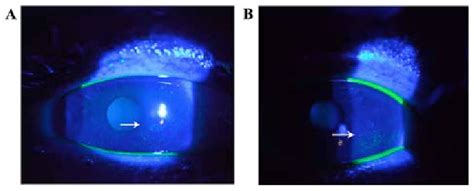 Fluorescein stain revealed the punctate epithelial erosions (indicated... | Download Scientific ...